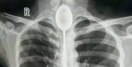 This x-ray image makes you speechless: man has a year-long...